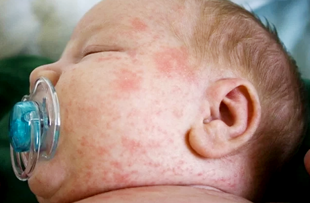 Bir insanda isti havada yaranan səpgilərə təmasla yoluxma mümkündürmü?