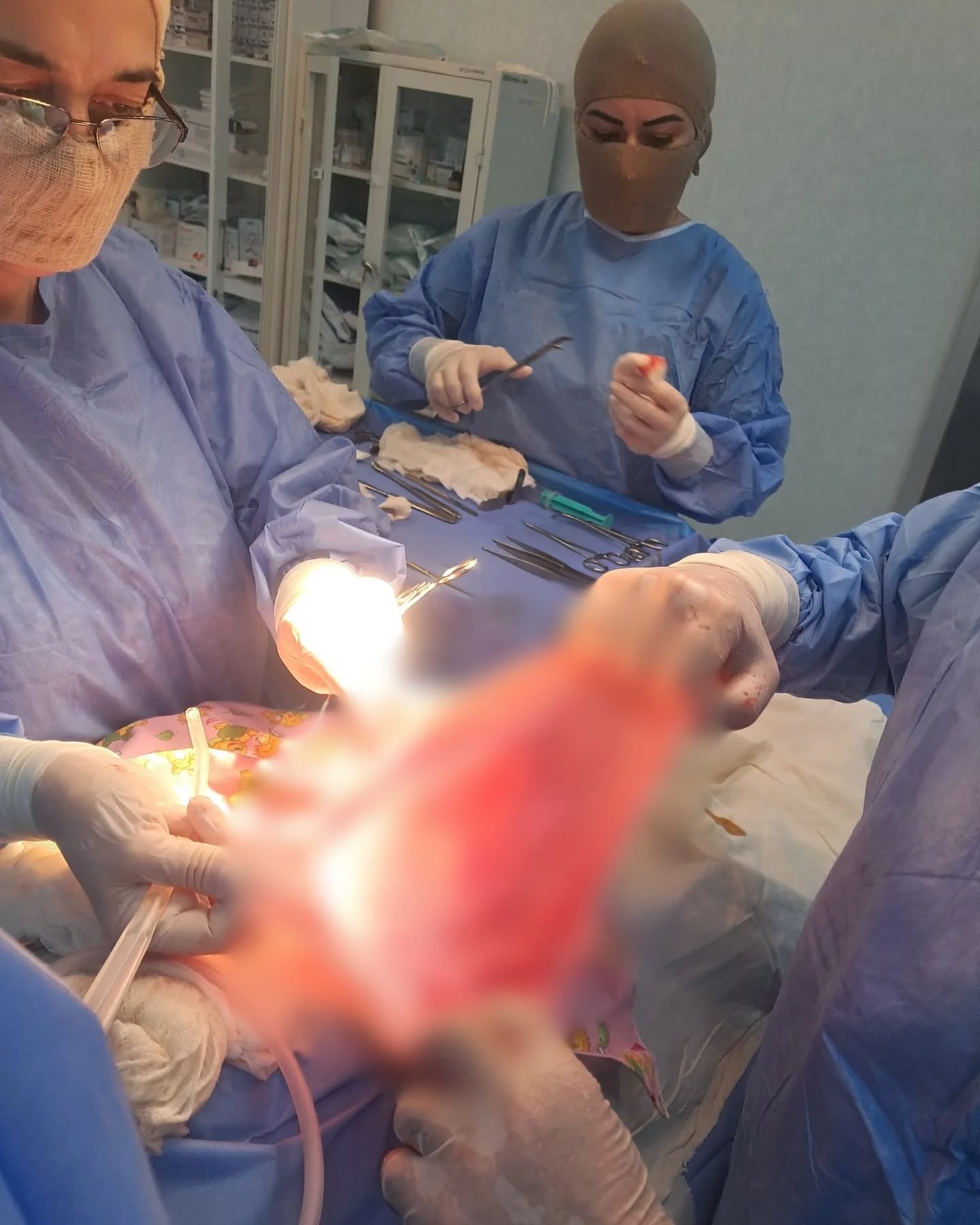  Pirallahı Tibb Mərkəzində daha bir riskli əməliyyat uğurla başa çatıb   