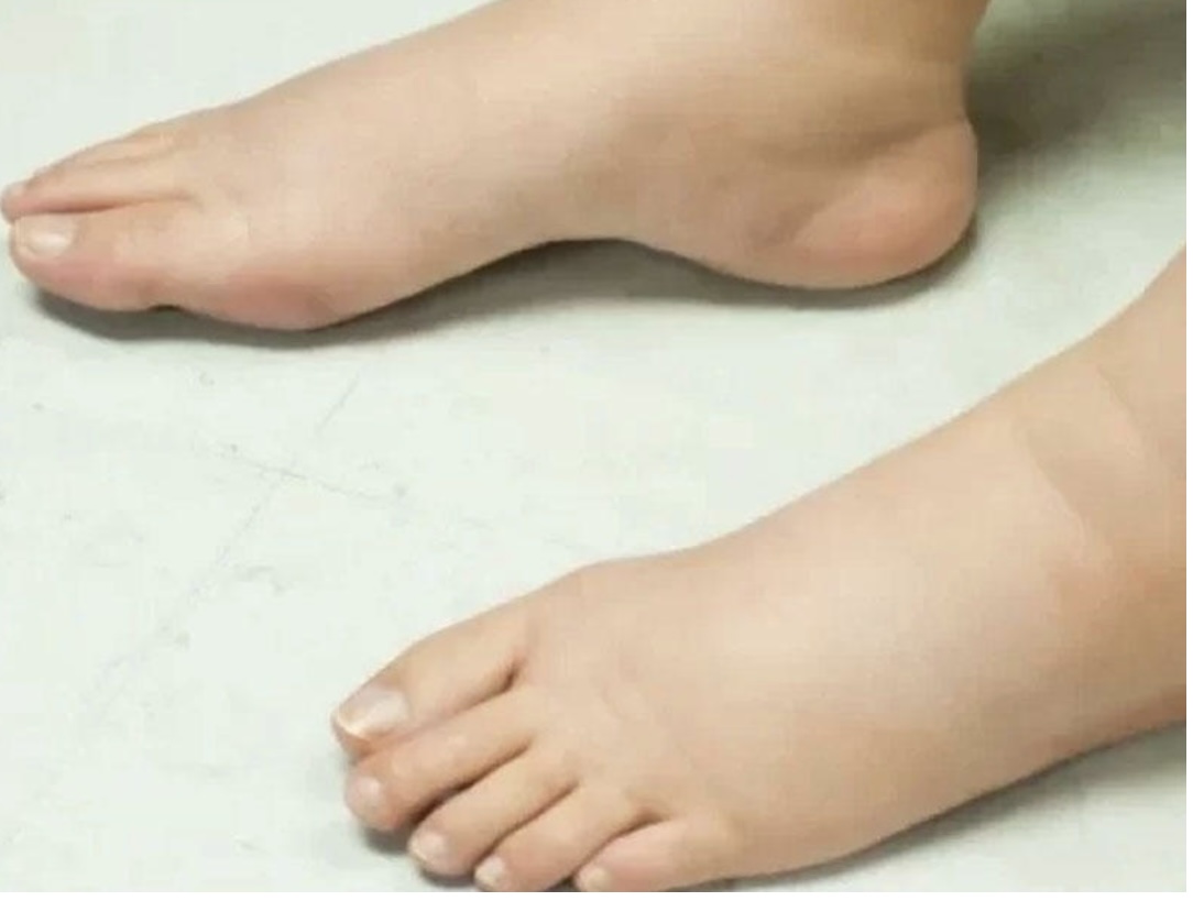 Ayaqlar nə üçün şişir?