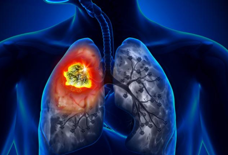 Ağciyər xərçəngi xərçənglə bağlı ölümlər arasında birinci yerdədir