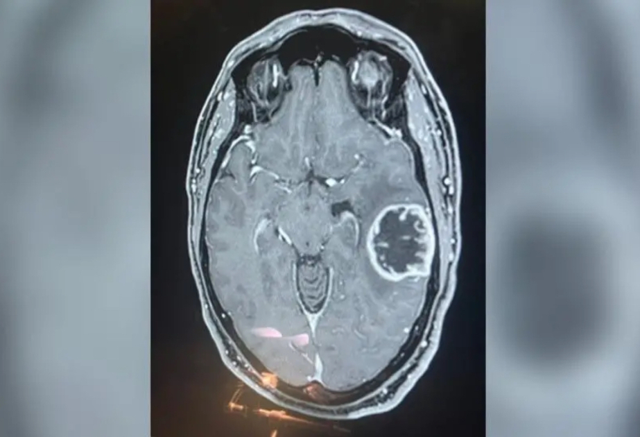 Britaniyada beyin şişlərini bir neçə saata müəyyən edən yeni test hazırlanıb  