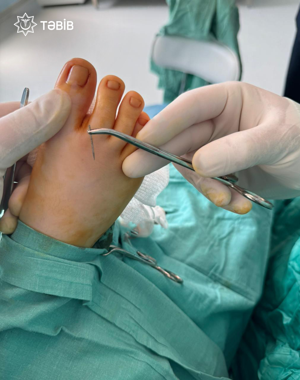  11 yaş uşağın ayağında qırılıb qalan iynə 14 gün sonra aşkarlandı   