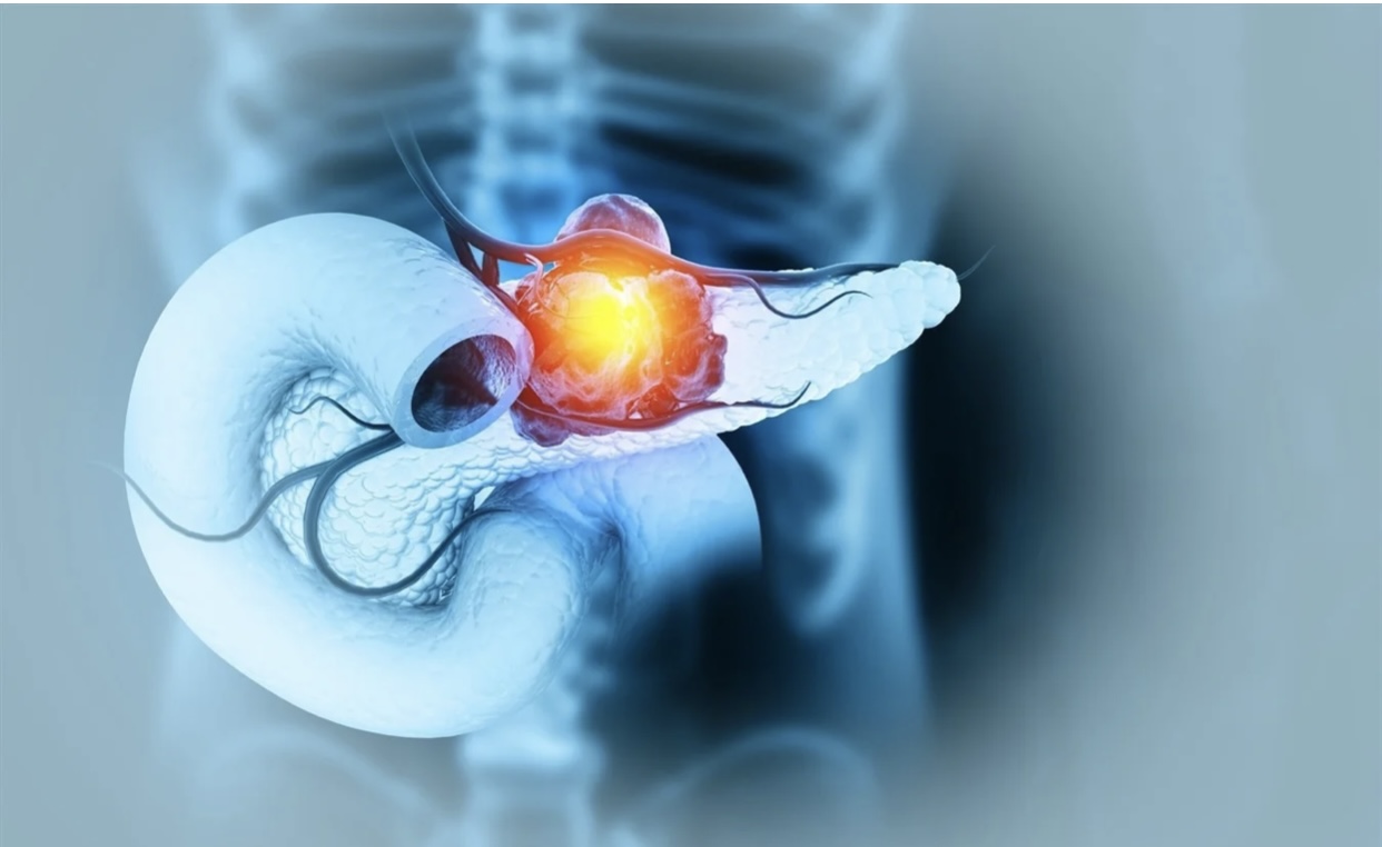 ÜST: Spirtli içkilər pankreas xərçəngi riski yaradır