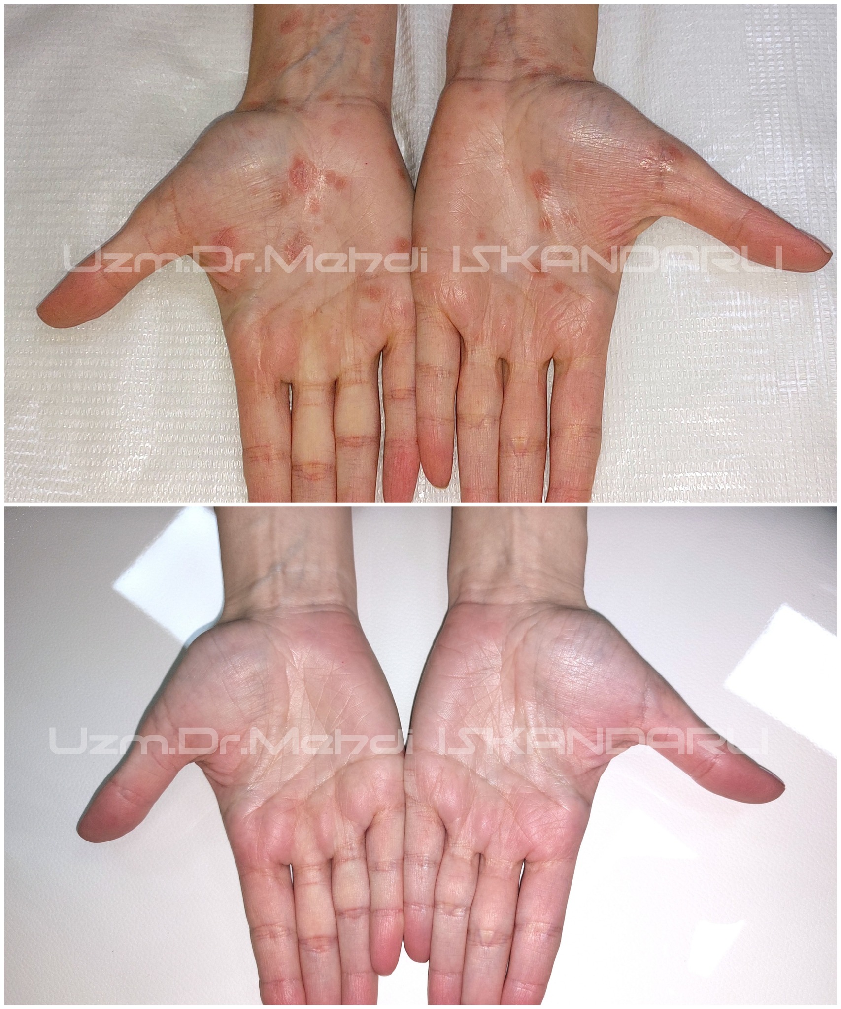 Əllərdə qabıqlı qızartılar - Dəmrov xətəliyi