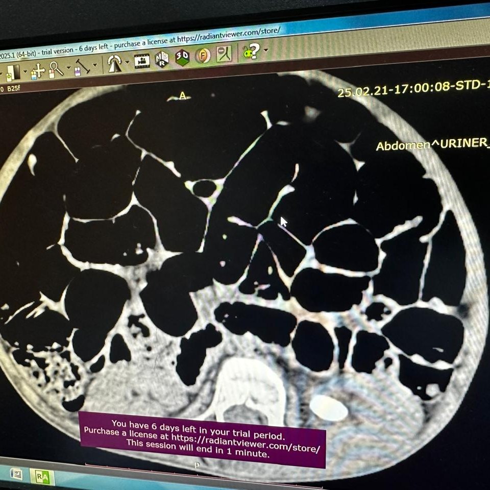  Nadir Rett sindromlu uşaq üzərində uğurlu əməliyyat icra olunub   