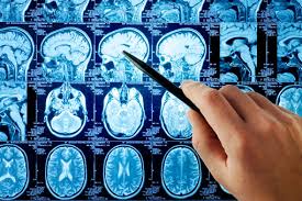 Aqressiv beyin xərçənginin müalicəsində irəliləyiş əldə olunub