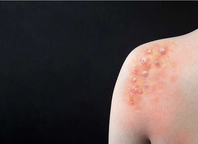 Bullyoz epidermolizi müalicə etmək mümkündürmü?