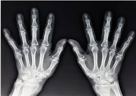 Sümük yaşı nədir və necə hesablanır?