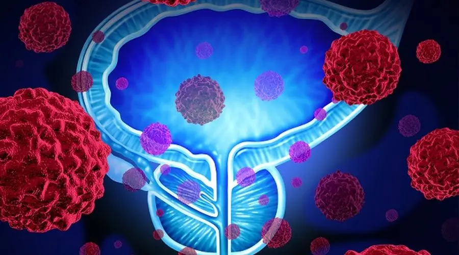 Prostat xərçəngində süni intellektdə irəliləyiş: Xəstələrin dörddə biri daha uzun yaşaya bilər