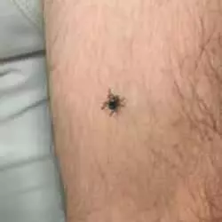 Türkiyədə gənə can aldı! 42 yaşlı qadın həyatını itirdi