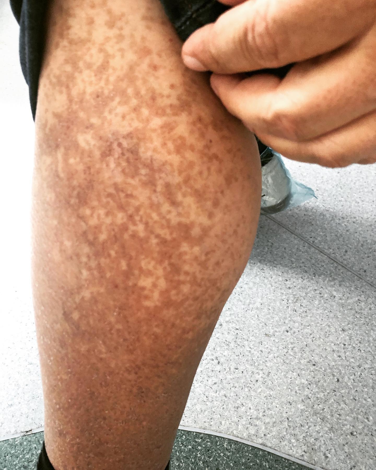 Dəridə baş verən dəyişikliklər qaraciyər xəstəliklərinin əlaməti ola bilər