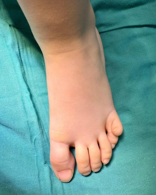 Polidaktiliya nədir?