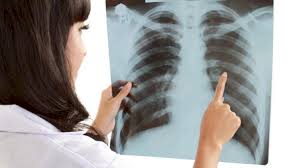 Ötən il Azərbaycanda 200-dən çox şəxs vərəmdən ölüb