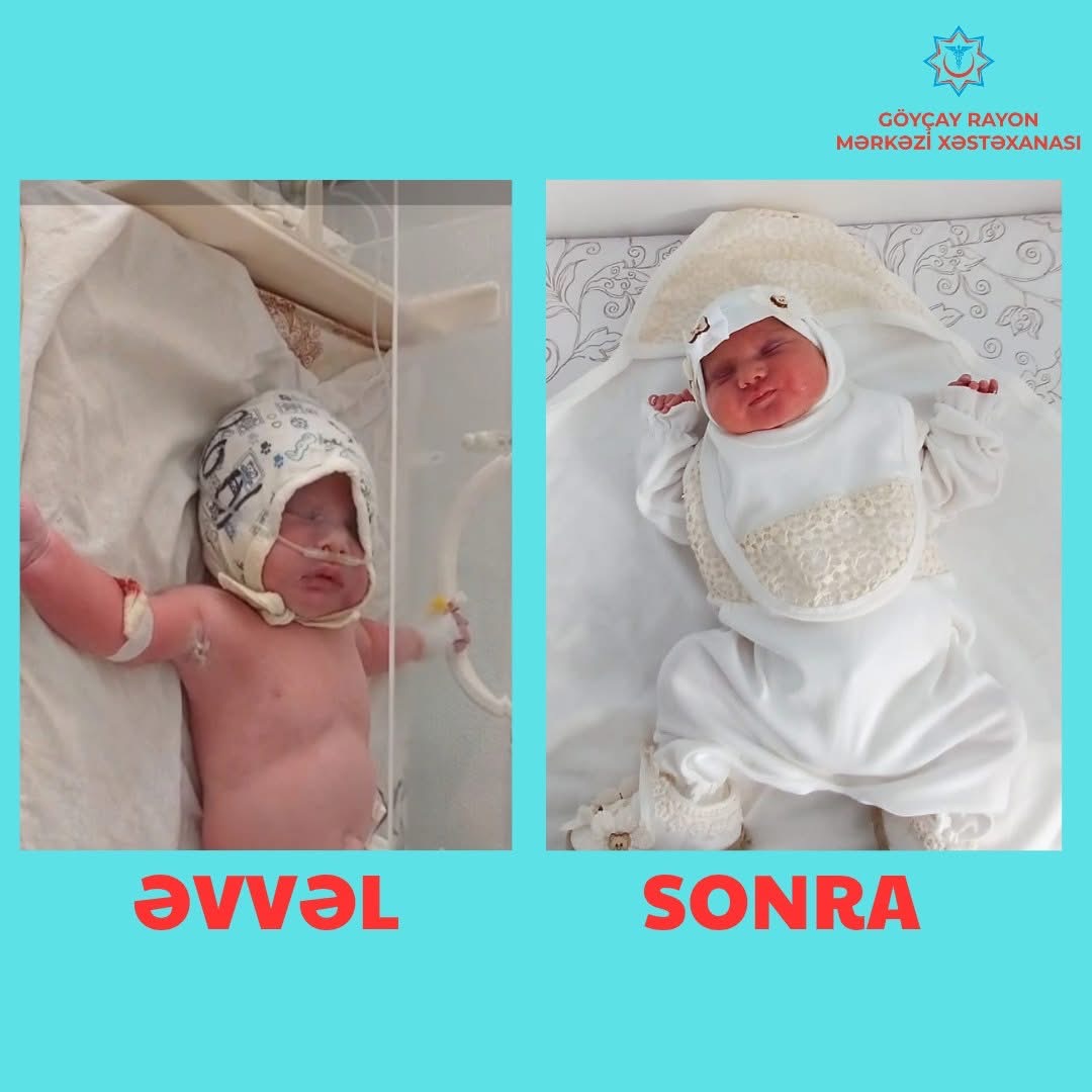 Göyçay RMX-da daha bir körpənin həyatı xilas edilib