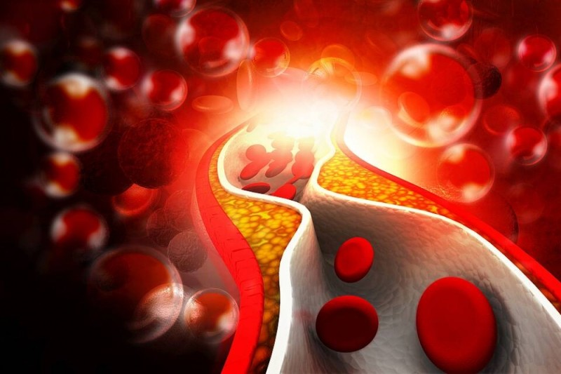 Xolesterin səviyyəsinin nəzarətsiz qalması on minlərlə infarkt və insultla nəticələnir