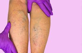 Varikozun yaranma səbəbləri nələrdir?