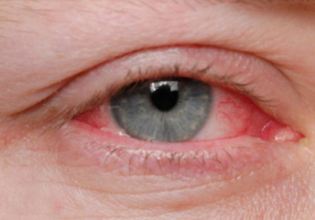 Qırmızı gözlər xəstəlik qaynağıdır  