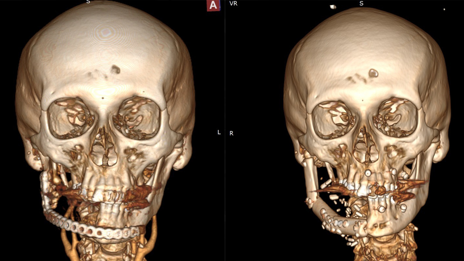 Səhiyyə Nazirliyindən 10 saatlıq unikal əməliyyat: Pasiyentin öz sümüyü ilə yeni çənə quruldu