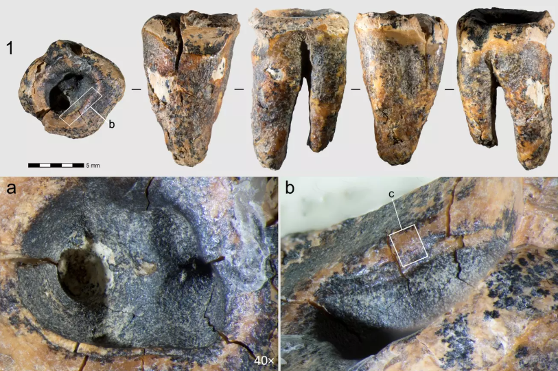 Keyitmə olmadan neandertallar kariyesi necə müalicə edirdi?