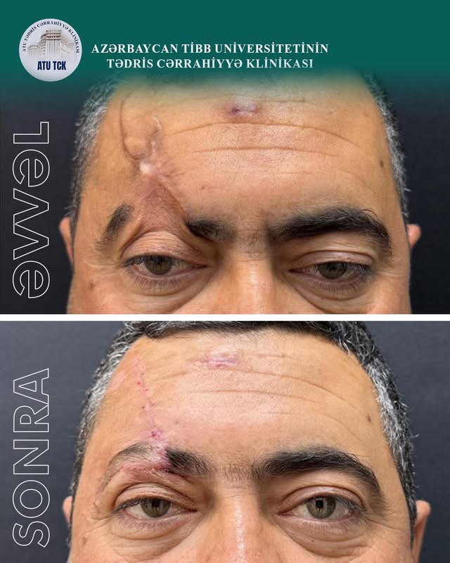 Mina partlayışından ağır zədə alan pasiyentin üzündə mürəkkəb rekonstruktiv-plastik əməliyyat aparılıb