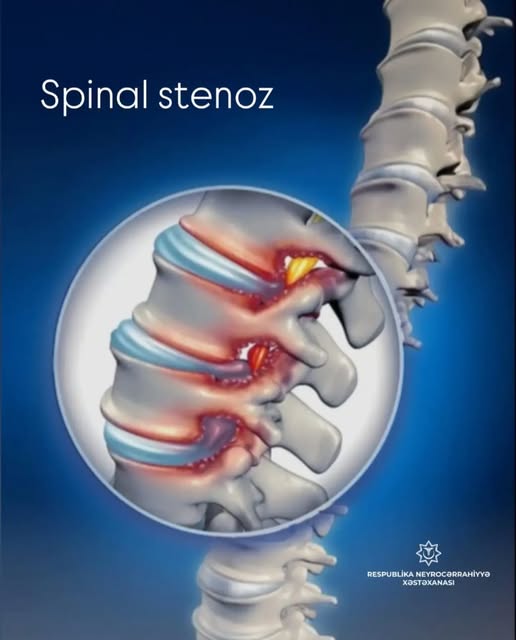  Spinal stenoz nədir?   