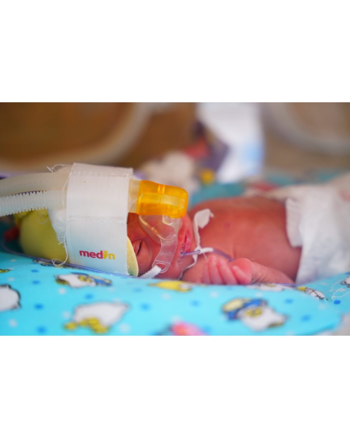  Quba Regional Perinatal Mərkəzində vaxtından əvvəl doğulan körpənin həyatı xilas edilib   