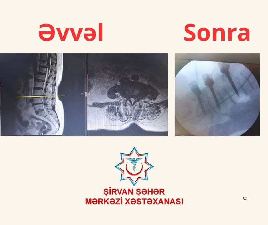 74 yaşlı pasiyent üzərində mürəkkəb onurğa əməliyyatı uğurla icra olunub