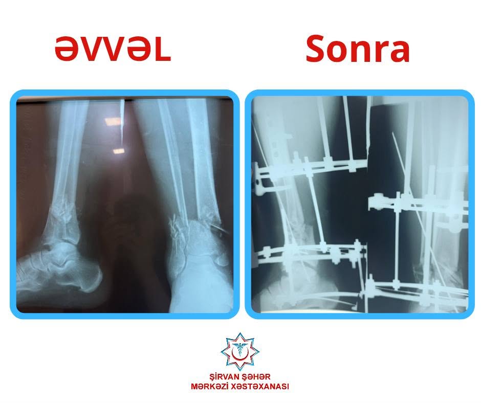  Şirvan Şəhər Mərkəzi Xəstəxanasında osteosintez əməliyyatı uğurla icra olunub   