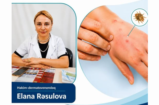 Qoturluqdan necə qorunmalı? – Dermatoloq əsas əlamət və profilaktik tədbirləri açıqlayır