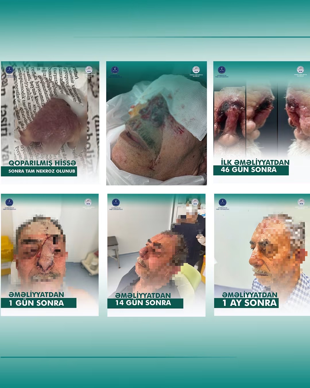 Tədris Cərrahiyyə Klinikasında unikal rekonstruktiv burun əməliyyatı uğurla icra olunub