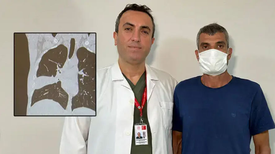 Xəstənin ağciyərindən sümük çıxarıldı – “Sümüklü yeməkləri sevən adamam, çox da təəccüblənmədim”