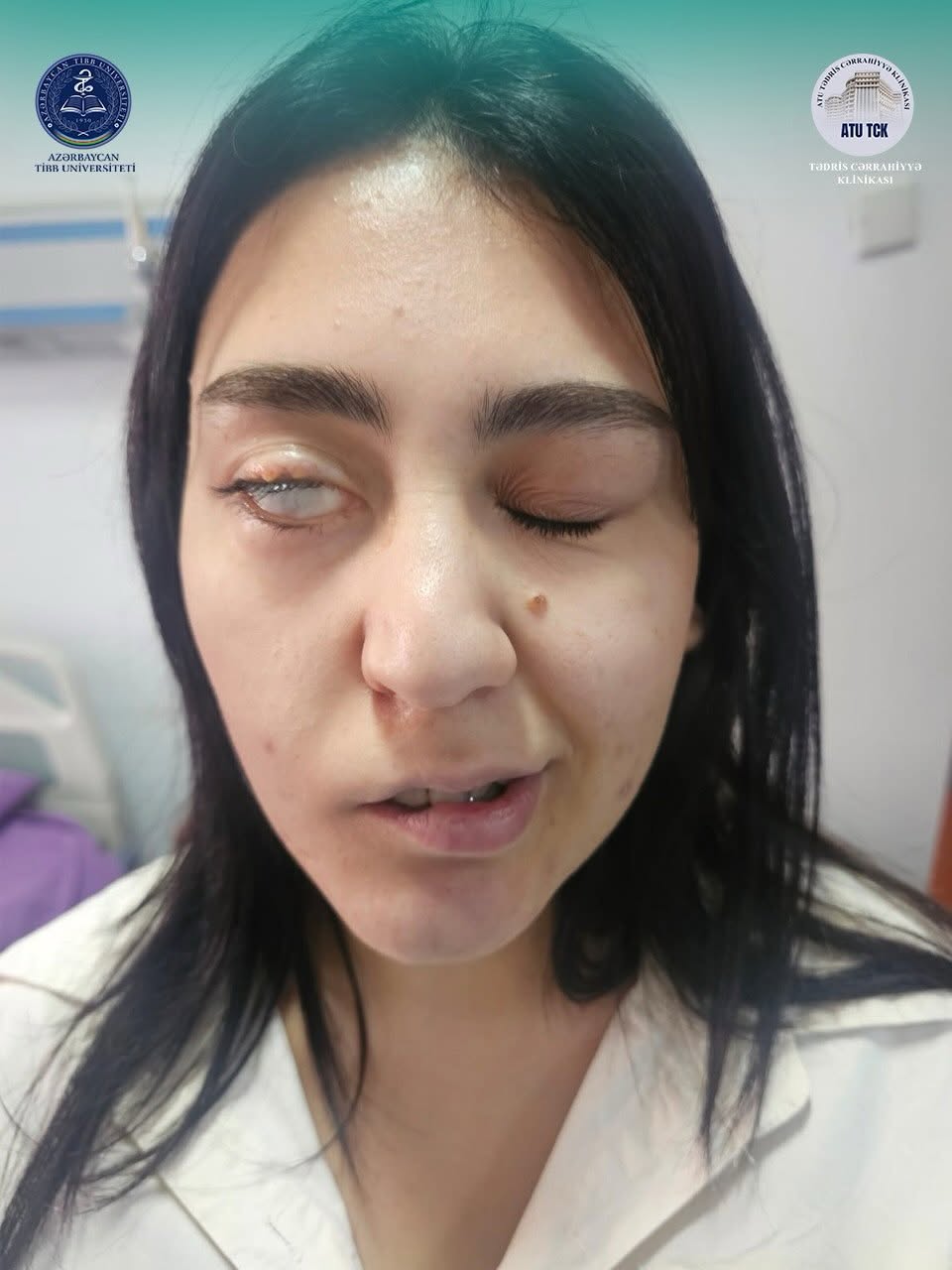 Tədris Cərrahiyyə Klinikasında mürəkkəb üz deformasiyalarının korreksiyasına dair çoxkomponentli cərrahi əməliyyat icra edilib