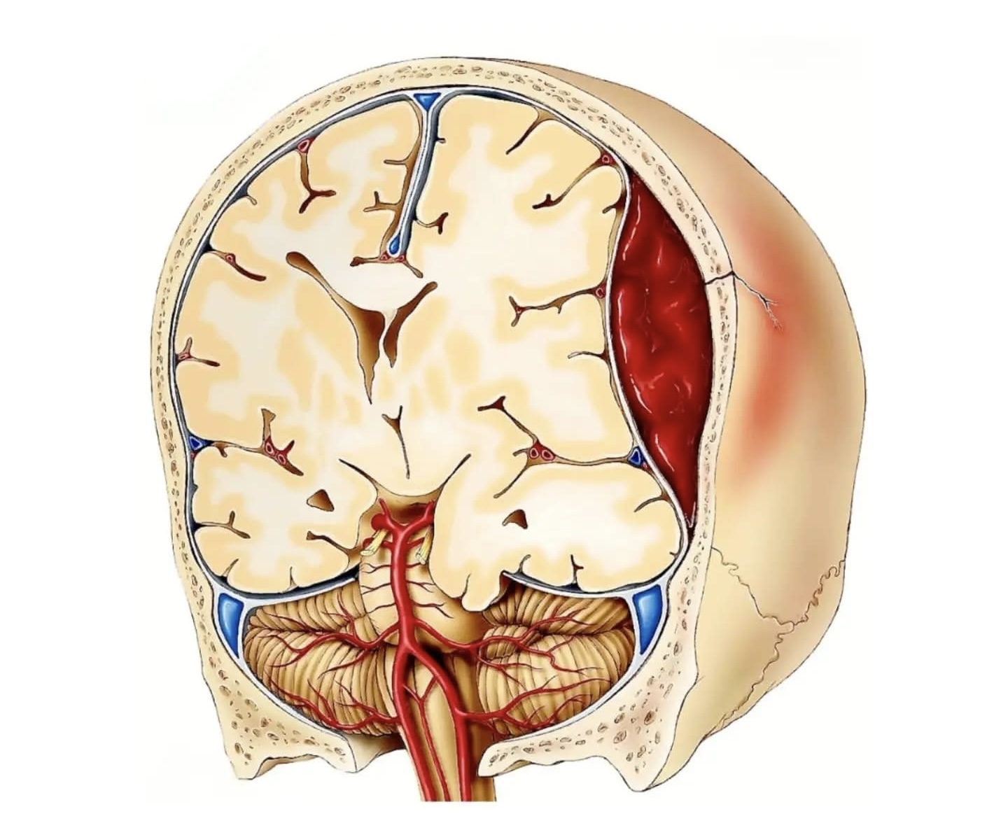 Epidural hematoma: Səbəbləri, əlamətləri və riskləri