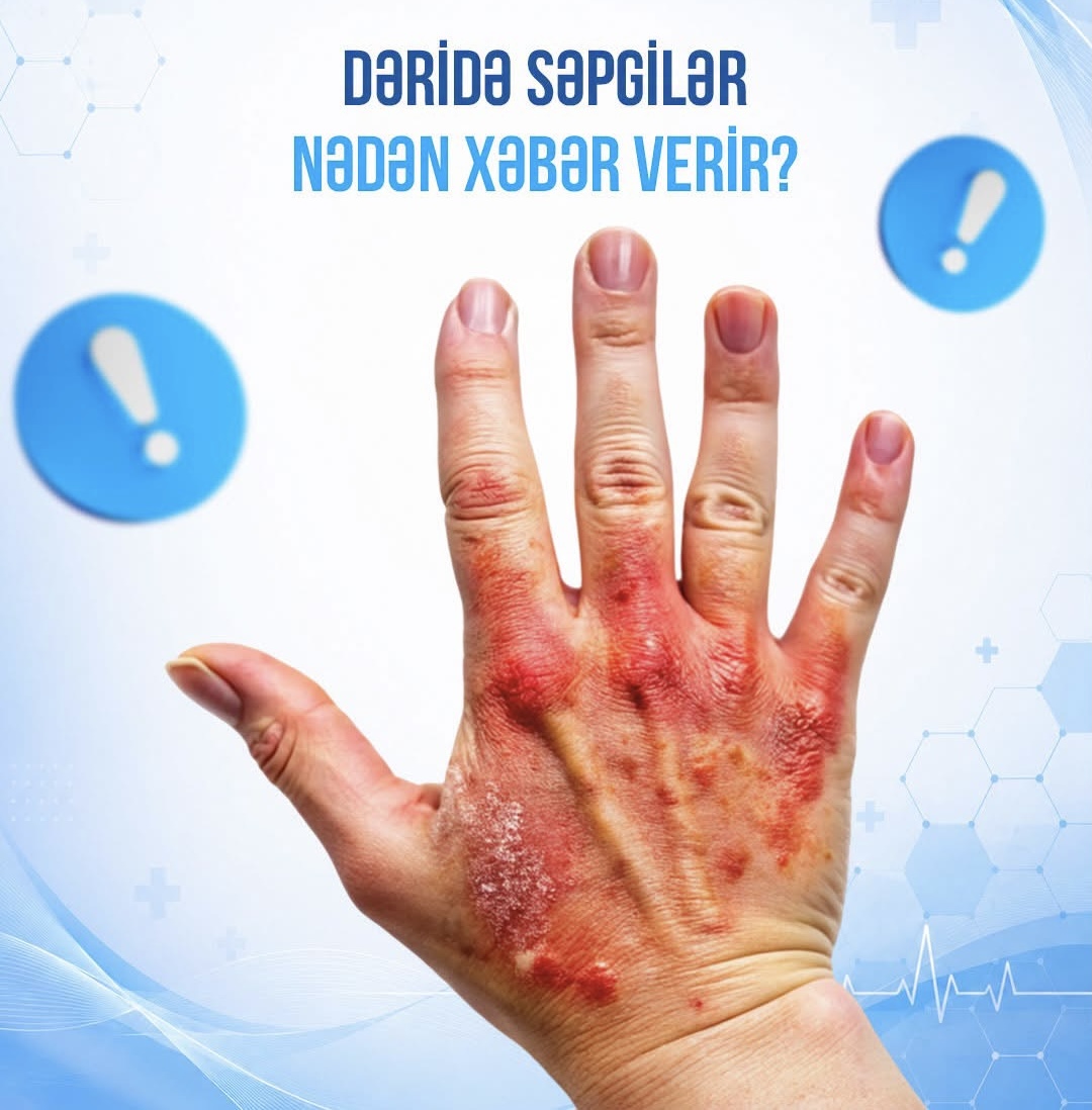 Dəridə səpgilər nədən xəbər verir?