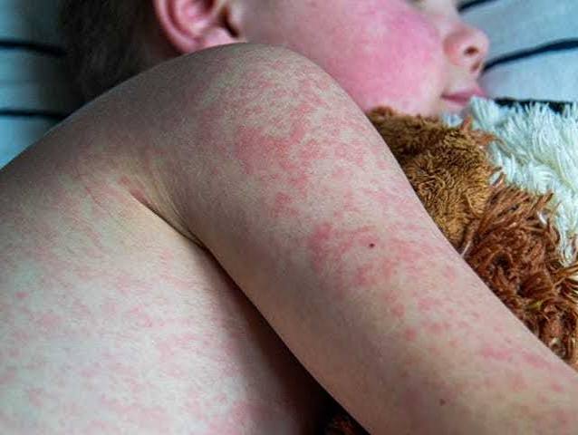 Pensilvaniyada qızılca epidemiyası qeydə alınıb  