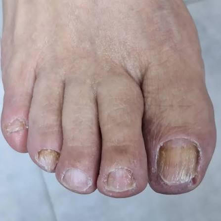 Diabetik ayaq sindromu